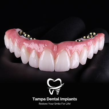 Hybrid Implant Bridge