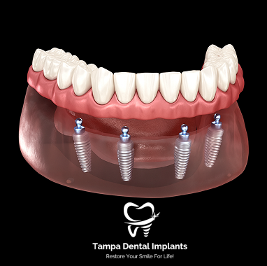 Zirconia Implant Bridge