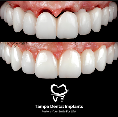 Porcelain Implant Bridge